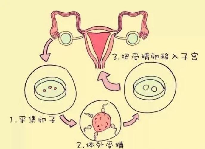 婴儿试管步骤_试管婴儿的全部流程_婴儿流程试管全部过程视频